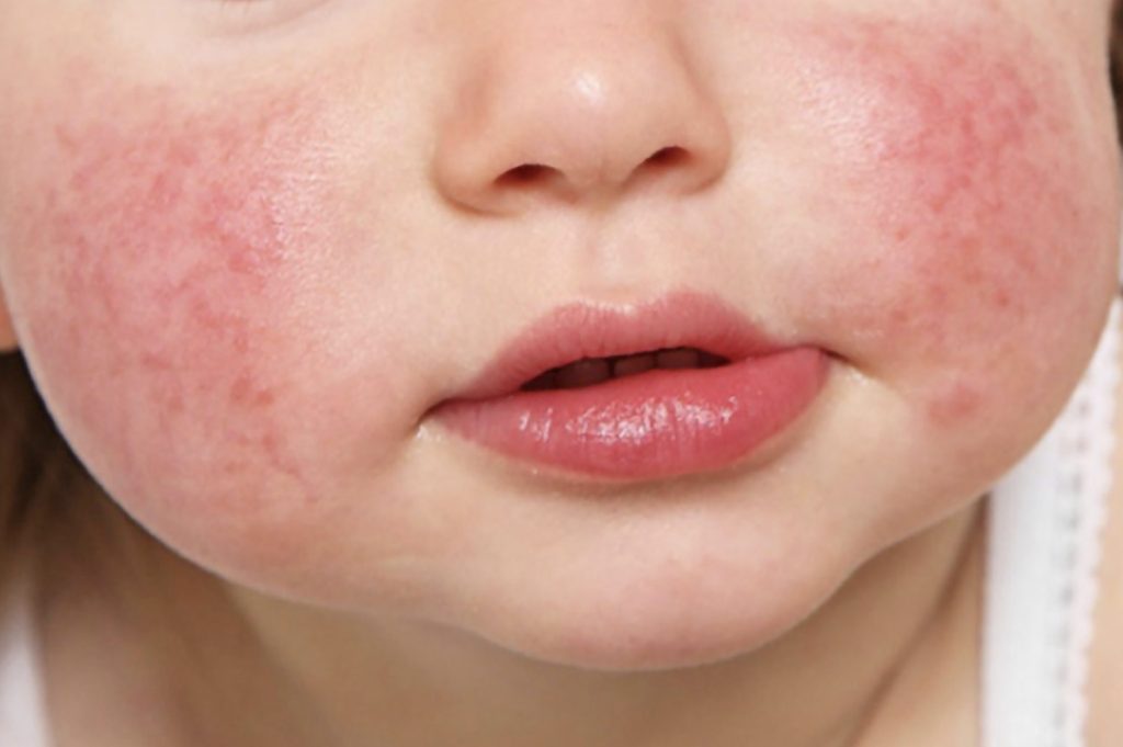 Parvovirus umano B19V